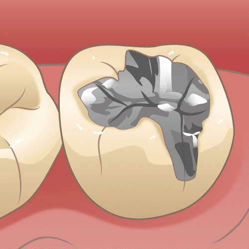 虫歯の部分を銀歯で被せたイラスト